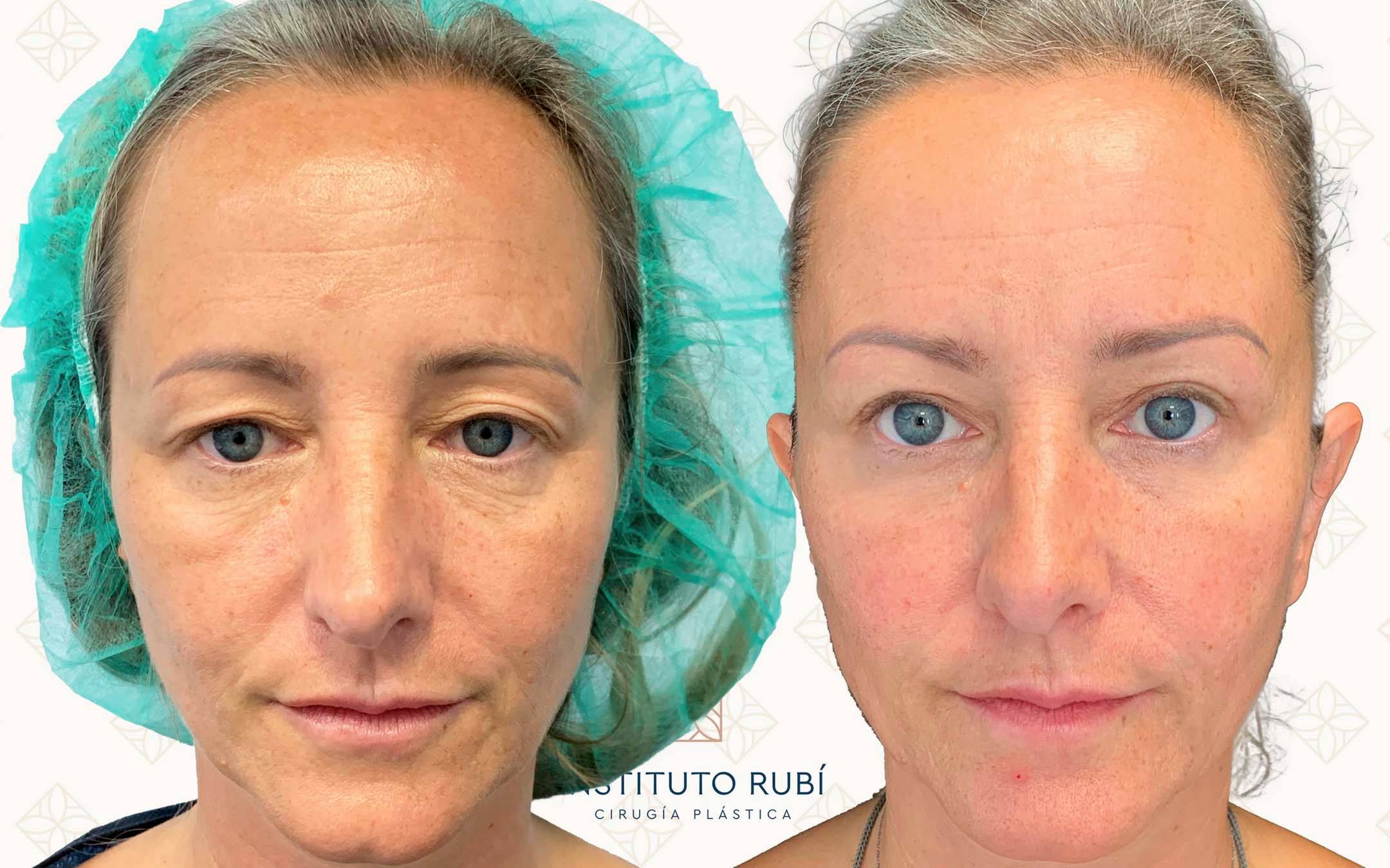 Comparación frontal antes y después de una blefaroplastia en Instituto Rubí