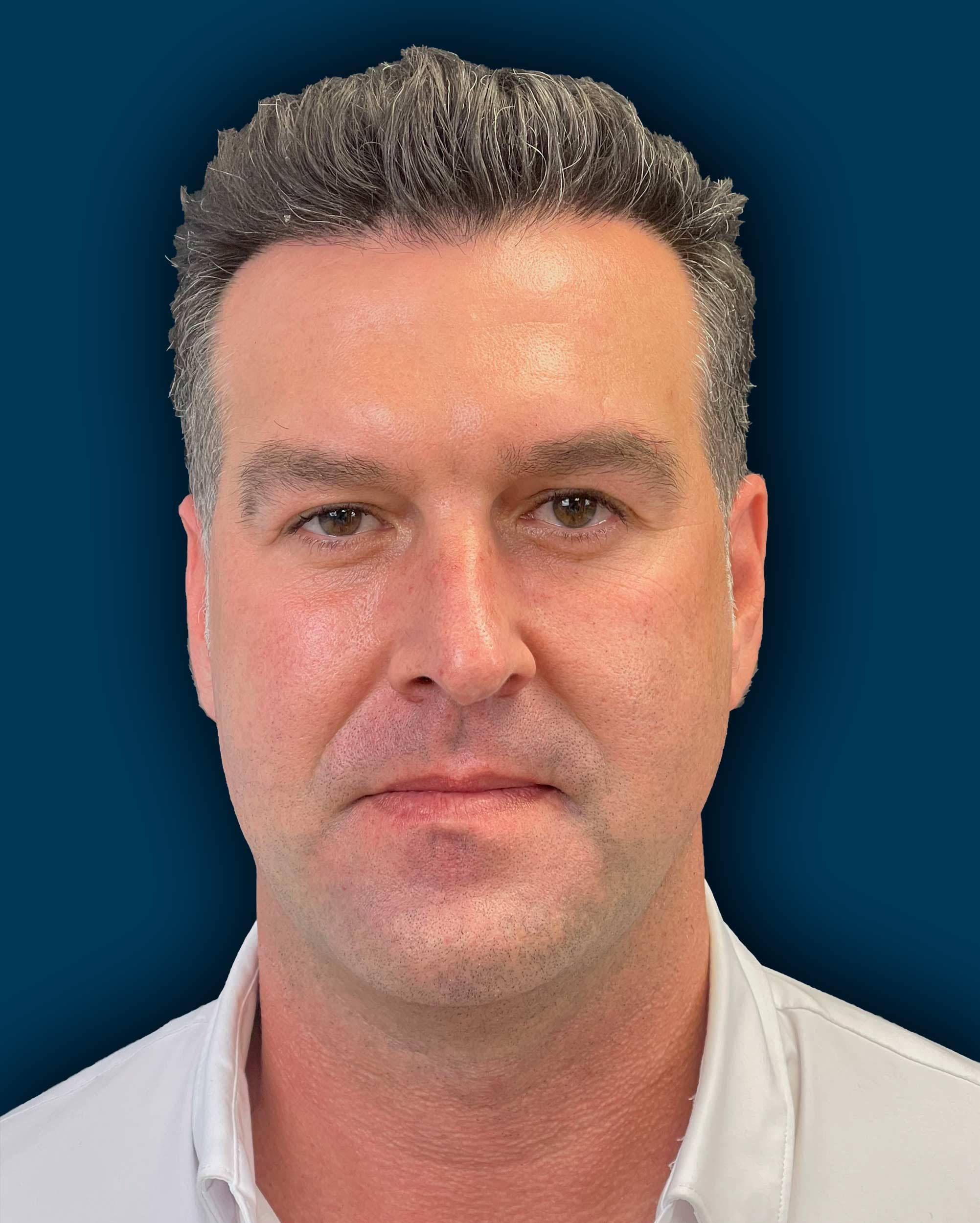 Blefaroplastia masculina caso 1 — mirada rejuvenecida después de la cirugía