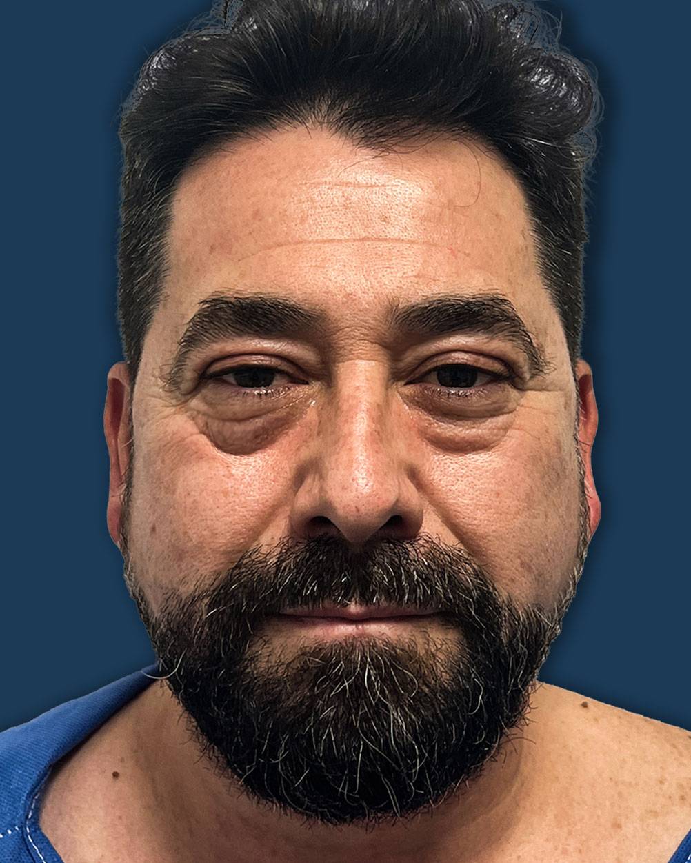 Cirugía de bolsas y ojeras caso 3 — antes de la blefaroplastia inferior