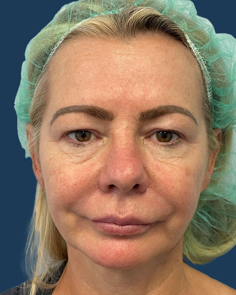 Blefaroplastia femenina caso 2 — párpados caídos y ojeras antes de la cirugía