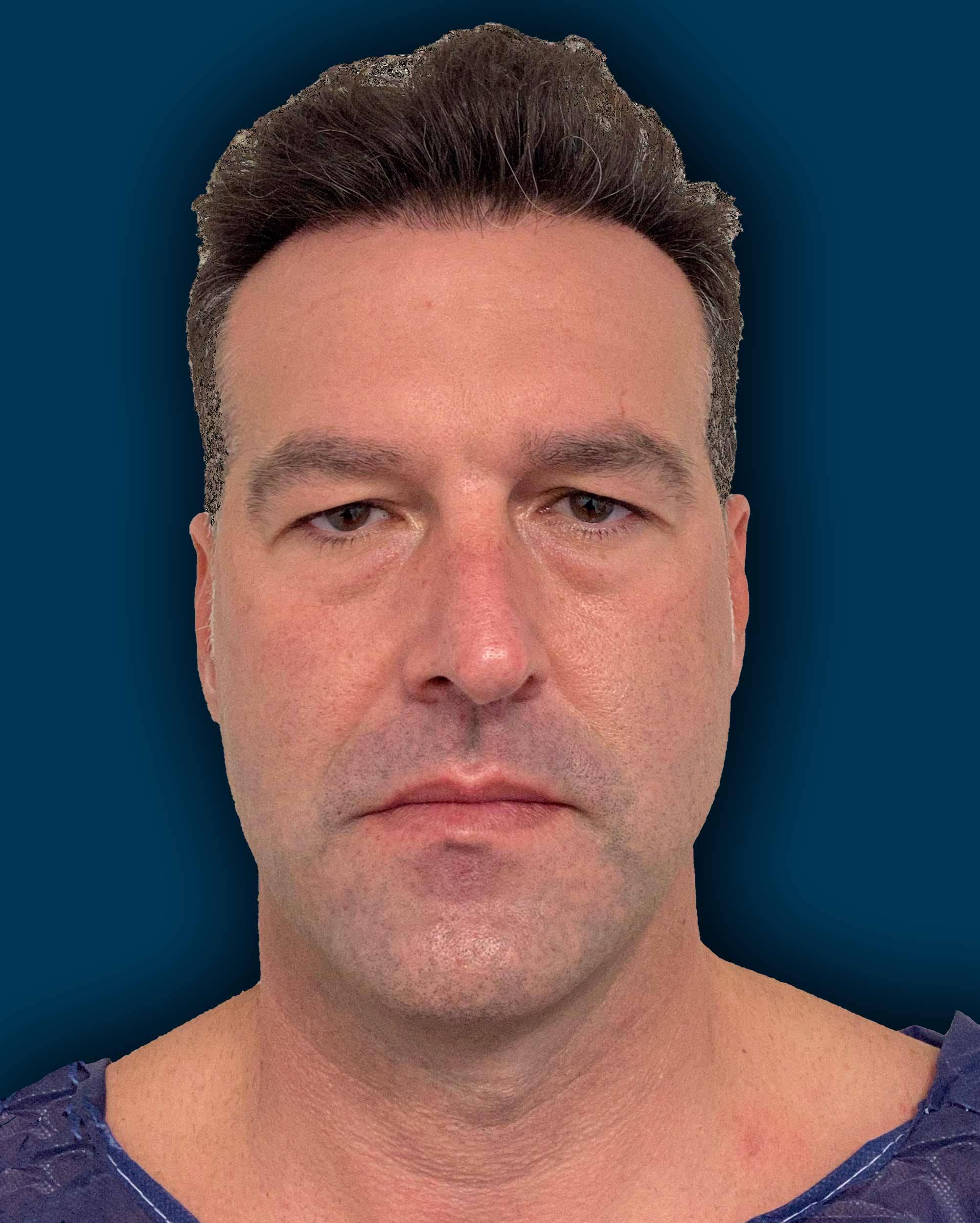 Blefaroplastia masculina caso 1 — párpados y bolsas antes de la cirugía
