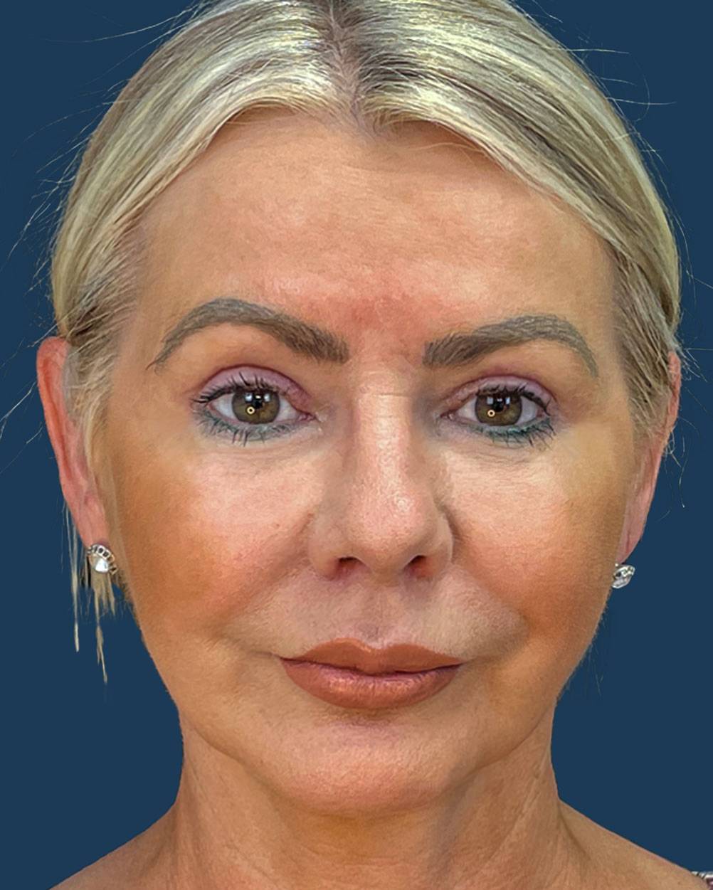 Blefaroplastia femenina caso 2 — resultado natural después de la cirugía de párpados
