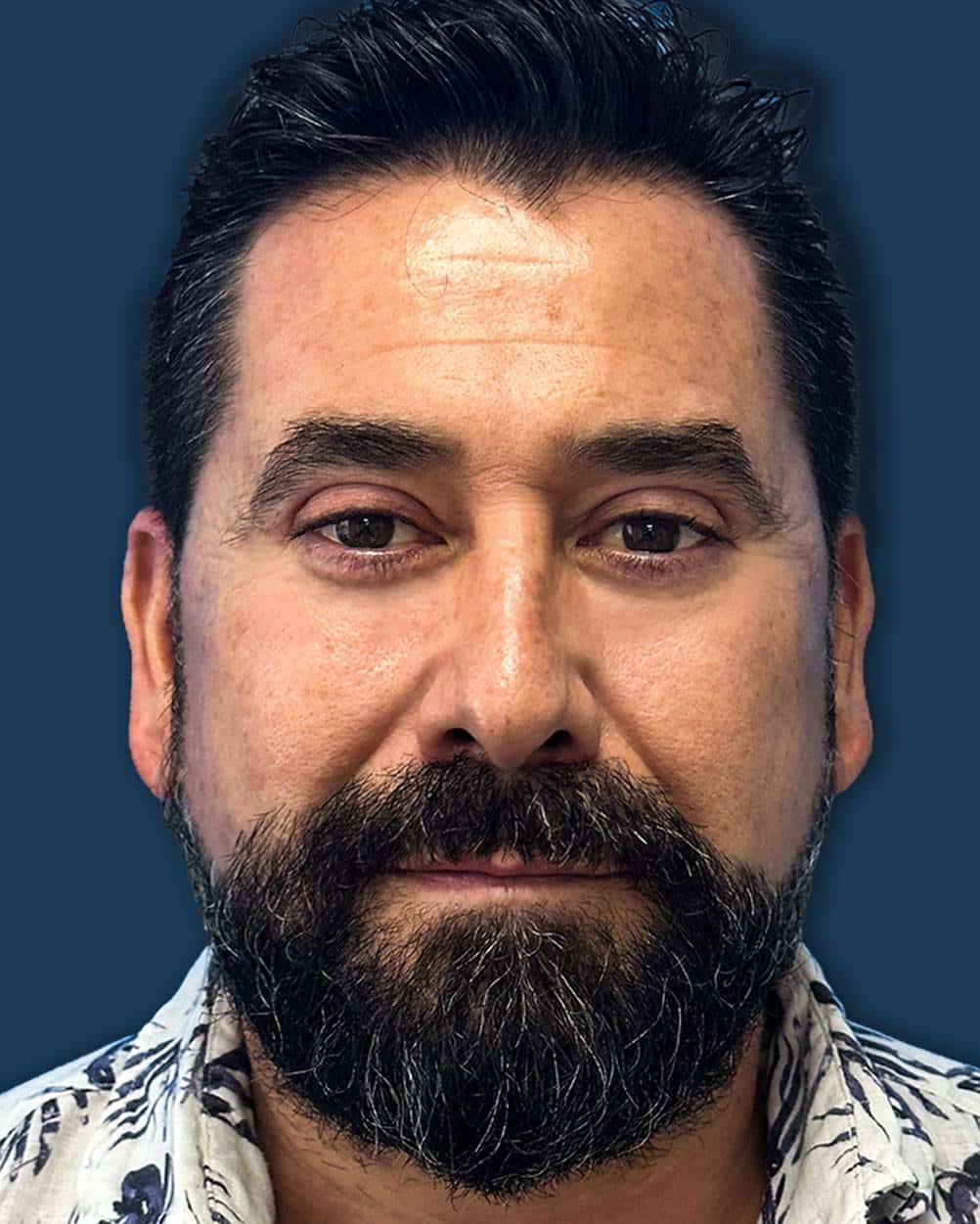 Cirugía de bolsas y ojeras caso 3 — después de la blefaroplastia inferior
